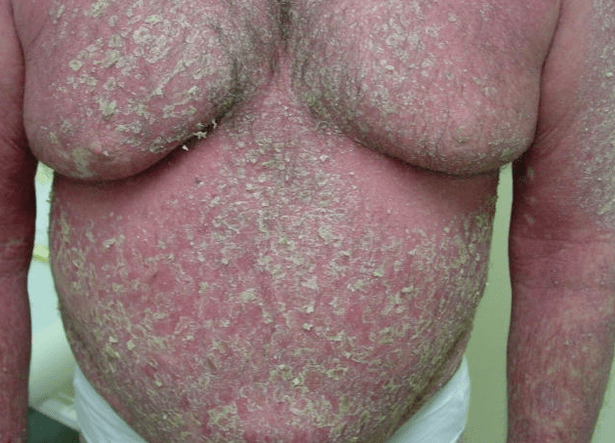 Erytrodermia łuszczycowa na ciele